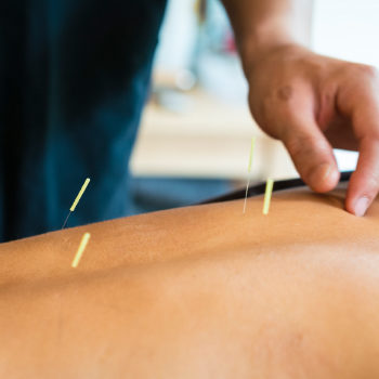 back-pain-acupuncture