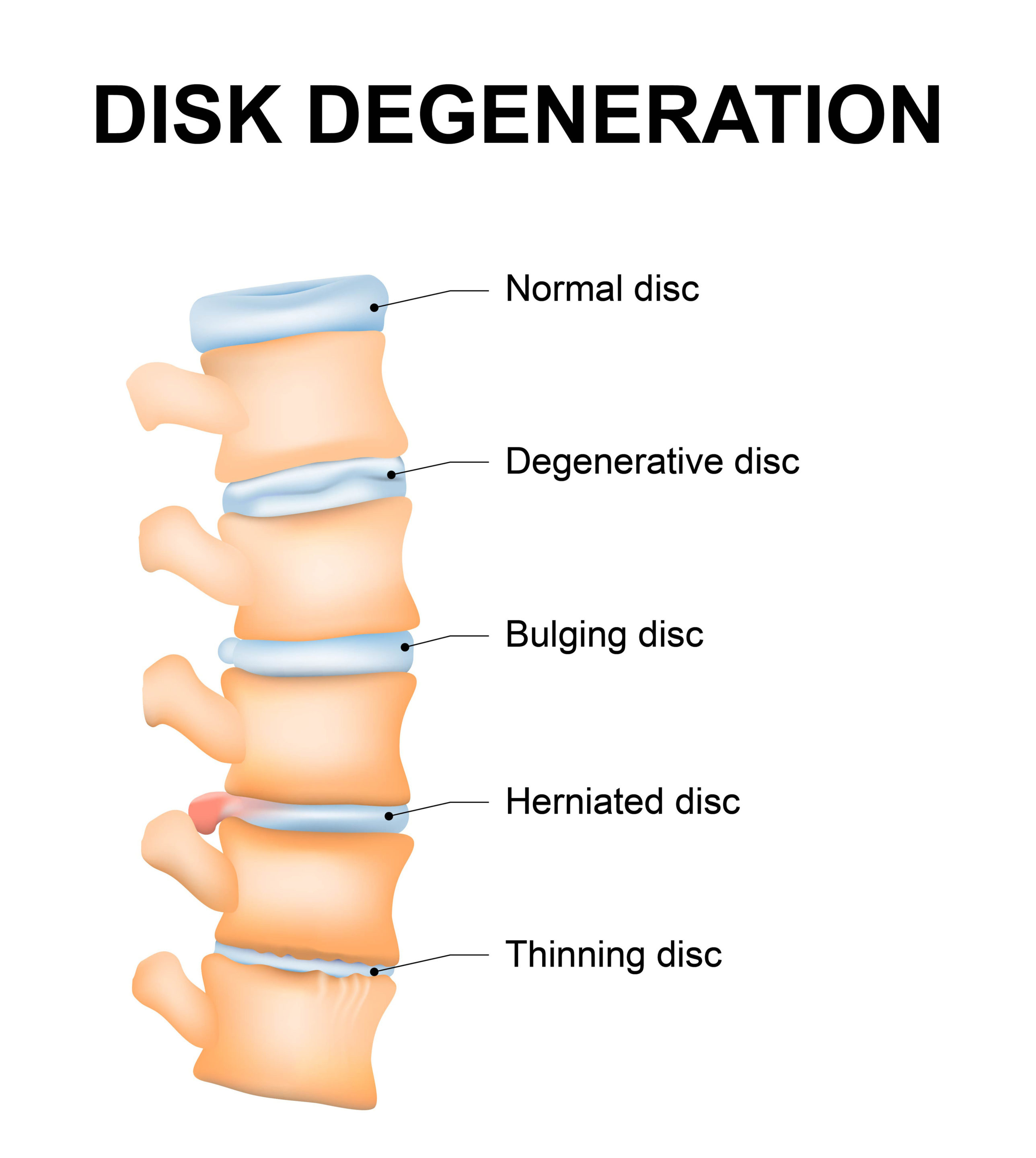 Disc degeneration