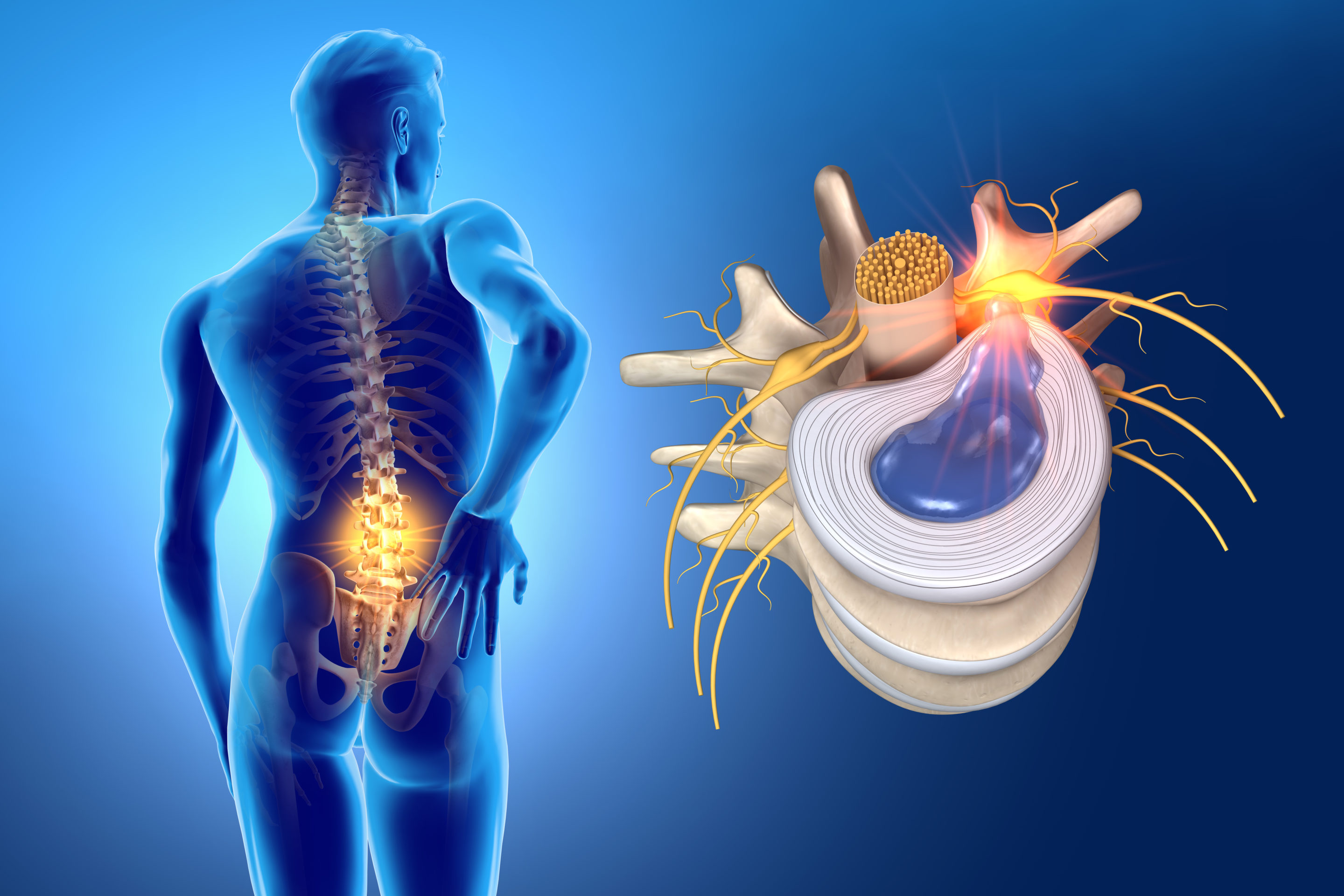 Herniated Disc vs Sciatica